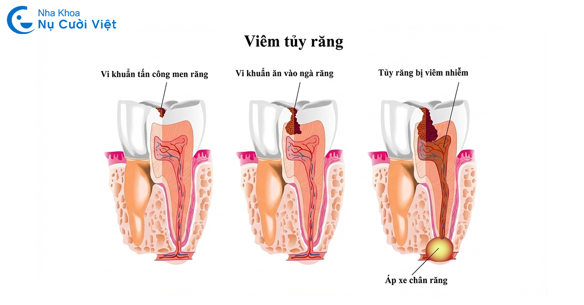 3 giai đoạn viêm tủy răng