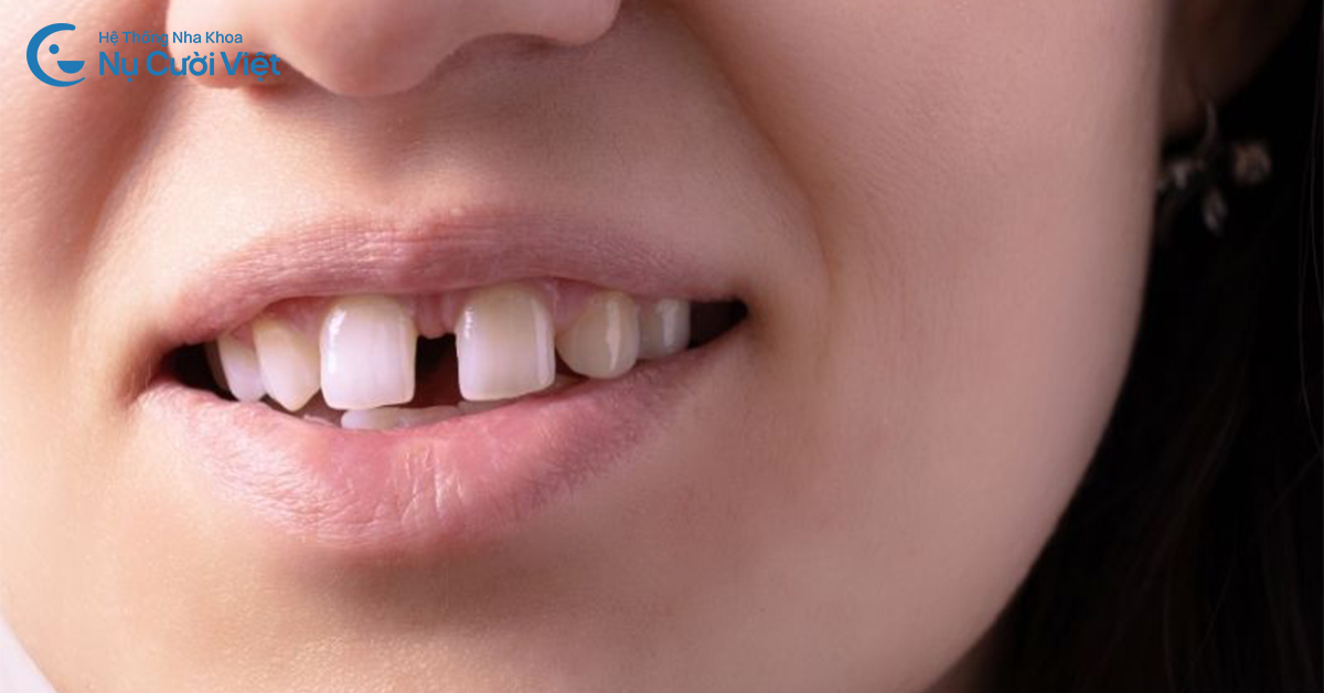 ảnh hưởng răng thưa đến thẩm mỹ
