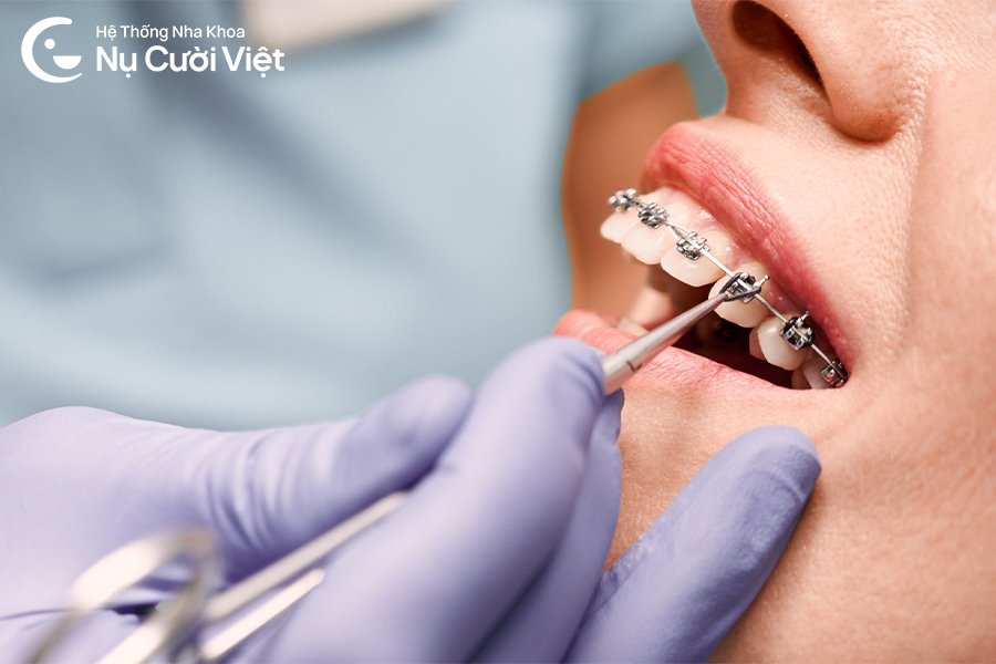 Nụ Cười Việt - Những dấu hiệu khi mới niềng răng? Trường hợp nào là bất thường?