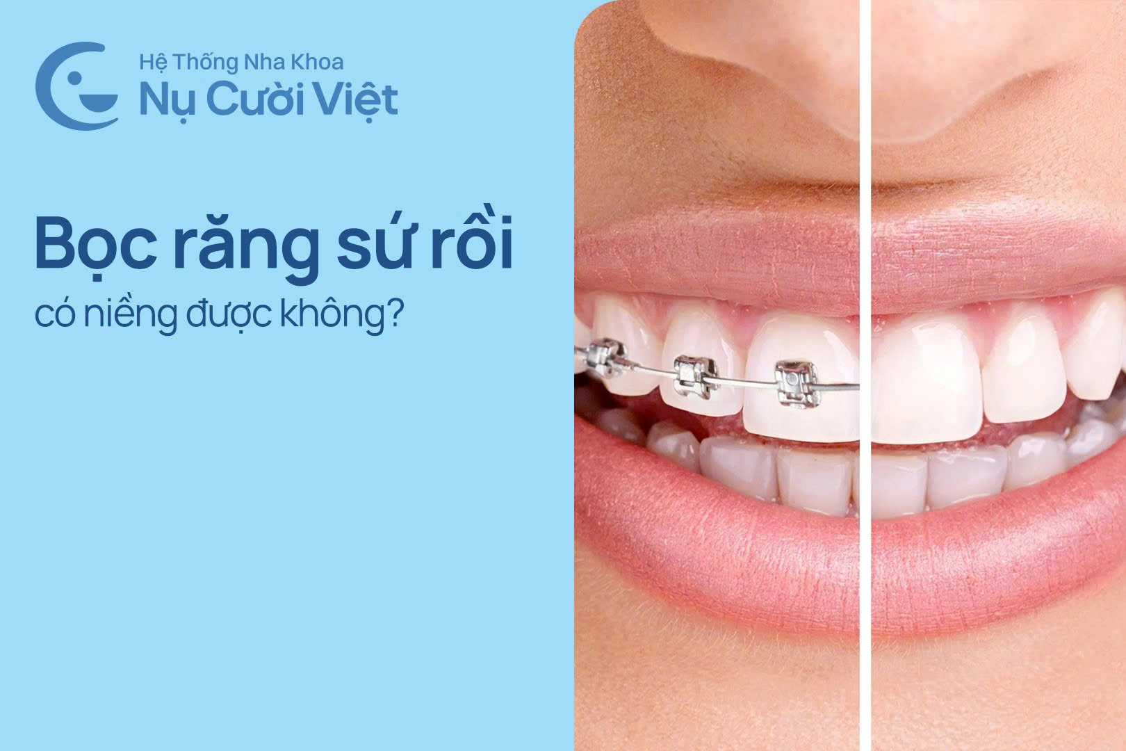 Nụ Cười Việt - Đã bọc răng sứ rồi có niềng được không? Có rủi ro gì không? 
