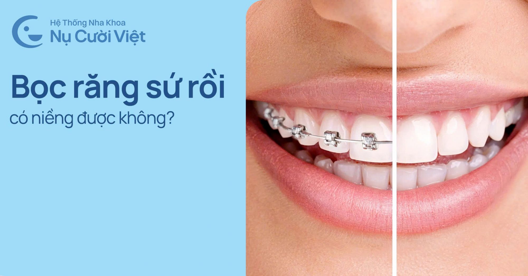 bọc răng sứ rồi có niềng được không