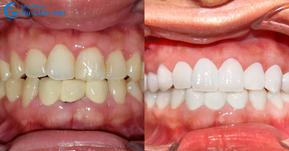 bọc sứ cho răng lộn xộn