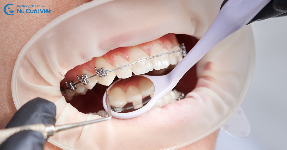 bọc sứ rồi niềng có được không