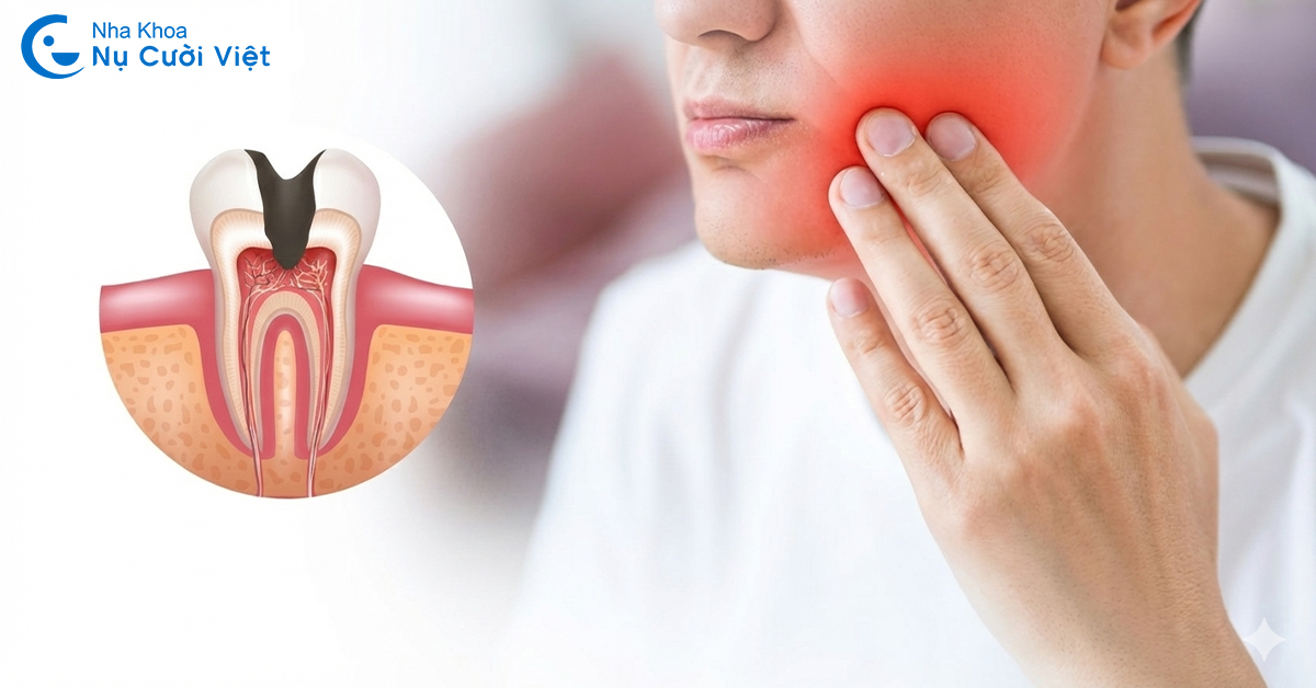 các giai đoạn của viêm tủy răng 