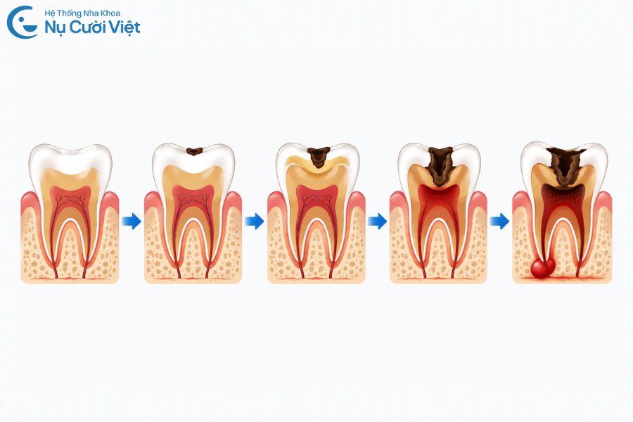 Nụ Cười Việt - 3 mức độ sâu răng từ nhẹ đến nặng: Dấu hiệu nhận biết và cách điều trị từng giai đoạn 