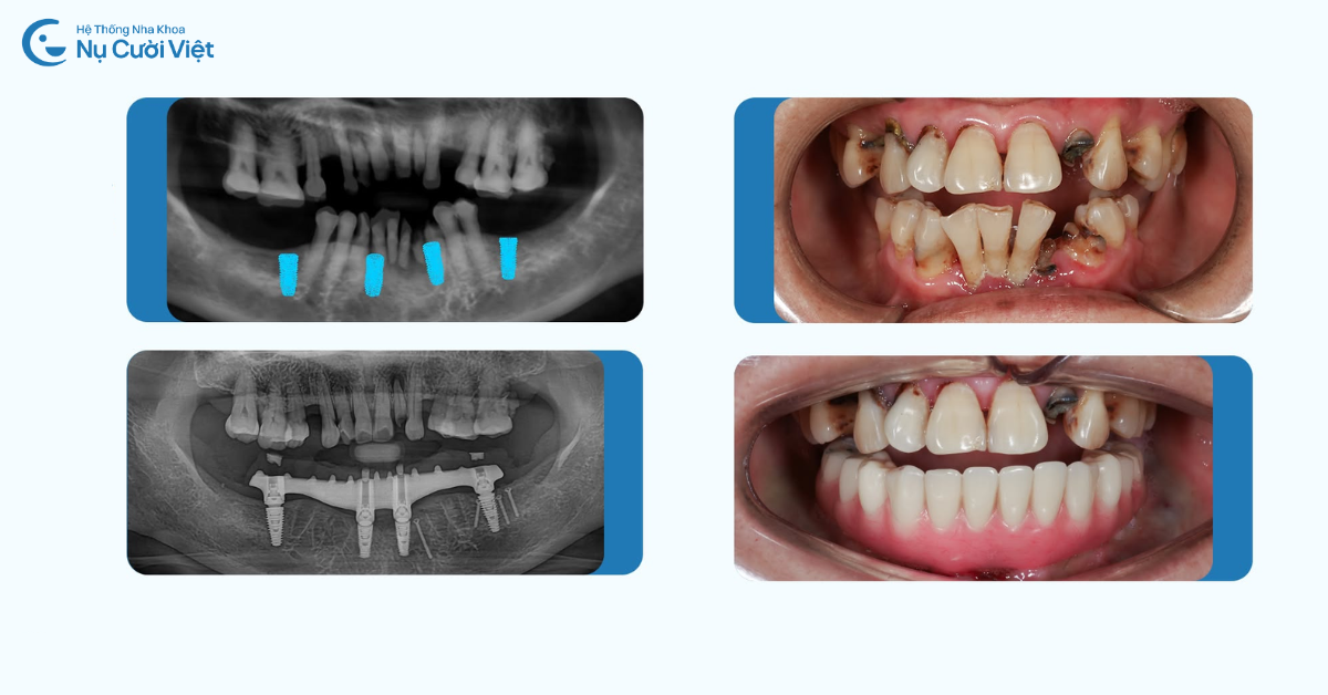 cấy ghép implant không đau tại nụ cười việt