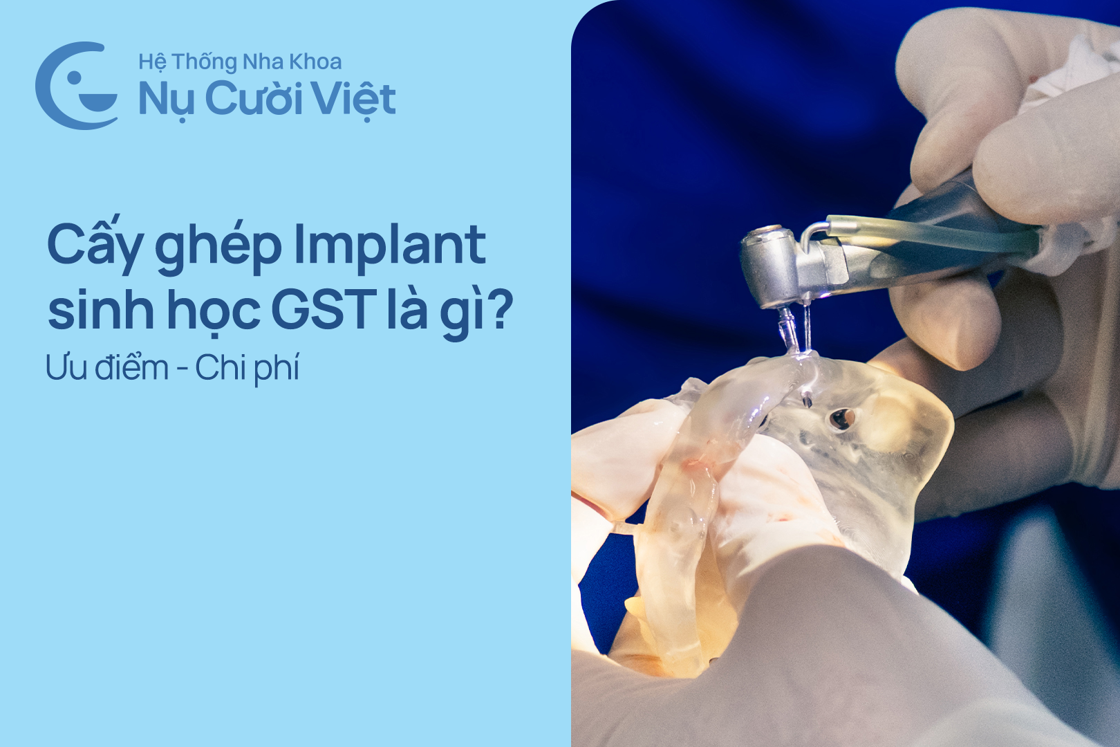 Nụ Cười Việt - CẤY GHÉP IMPLANT SINH HỌC GST LÀ GÌ? ƯU ĐIỂM VÀ CHI PHÍ RA SAO?