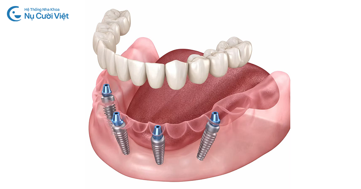 cấy ghép implant toàn hàm all on 4 là gì
