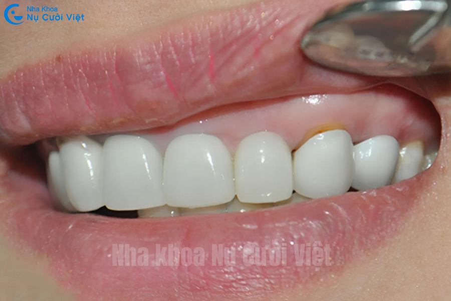Nụ Cười Việt - CÁCH CHĂM SÓC SAU KHI BỌC RĂNG SỨ ĐẢM BẢO ĐỘ BỀN TRỌN ĐỜI