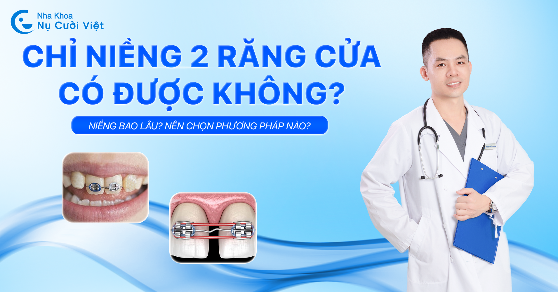 chỉ niềng 2 răng cửa có được không nha khoa nụ cười việt