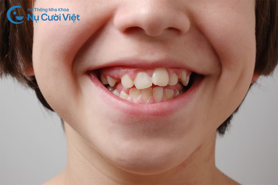 Nụ Cười Việt - Chi phí niềng răng trẻ em là bao nhiêu? Nên chọn phương pháp niềng nào?