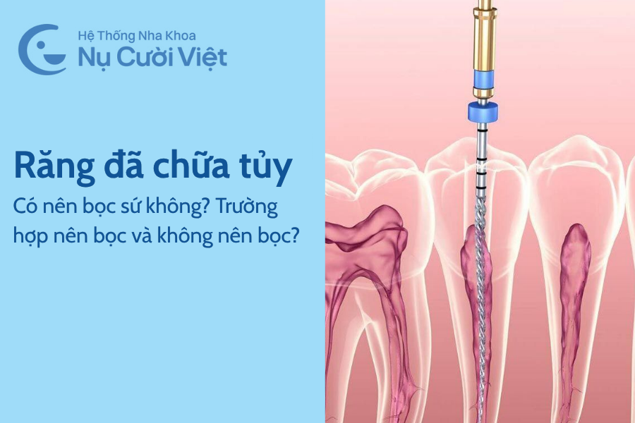 Nụ Cười Việt - Có nên bọc sứ cho răng đã chữa tủy không? Trường hợp nên bọc và không nên bọc