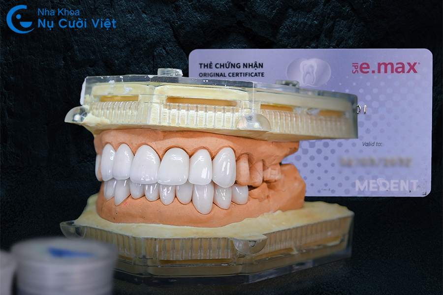 Nụ Cười Việt - DÁN SỨ VENEER CÓ BỀN KHÔNG? YẾU TỐ ẢNH HƯỞNG ĐỘ BỀN CỦA DÁN SỨ VENEER