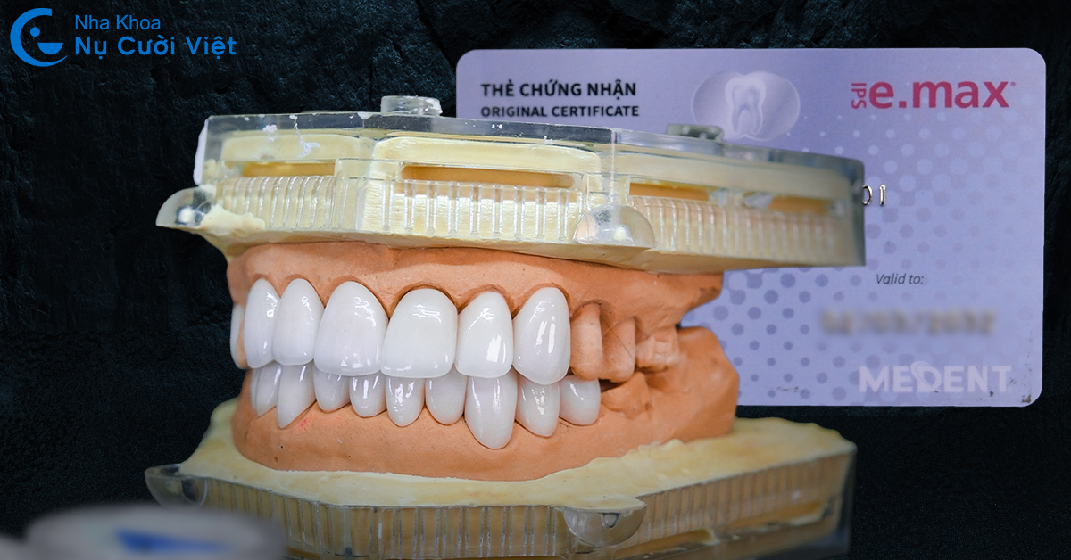 mặt dán sứ veneer có bền không