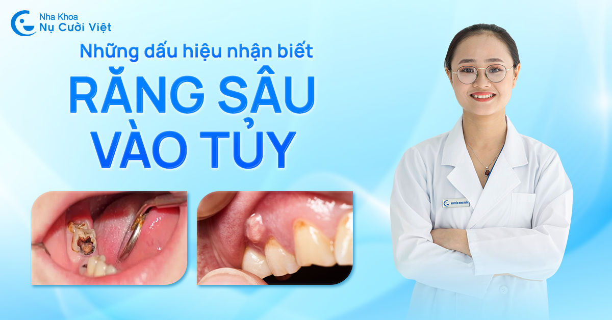 những dấu hiệu nhận biết răng sâu vào tủy