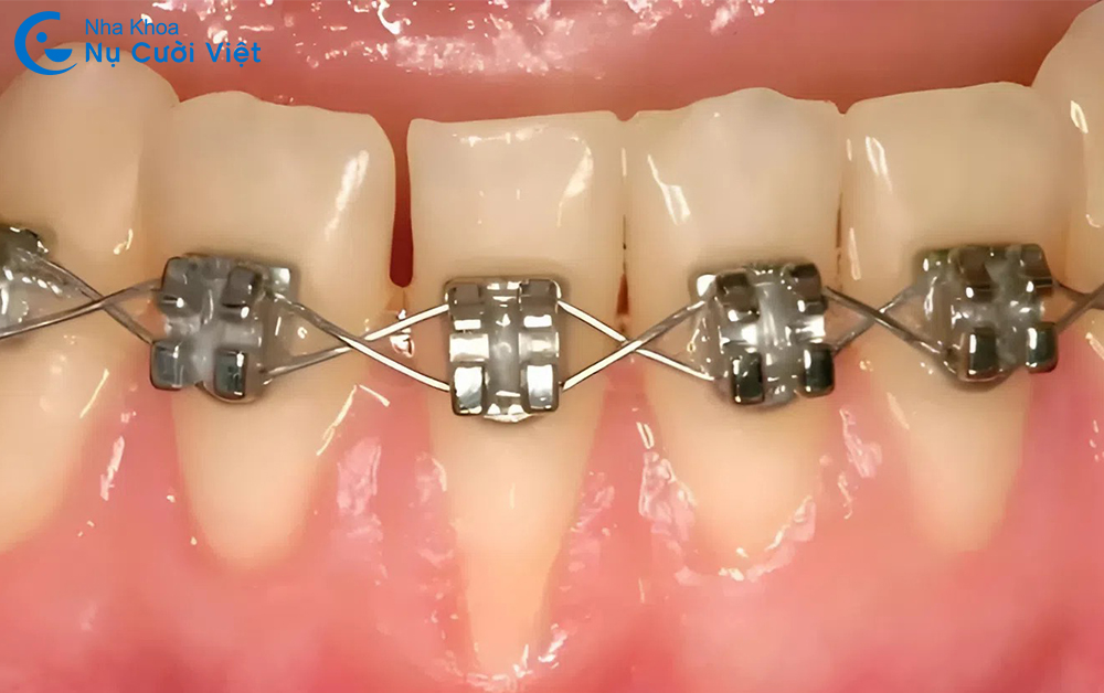 dấu hiệu tụt lợi khi niềng răng