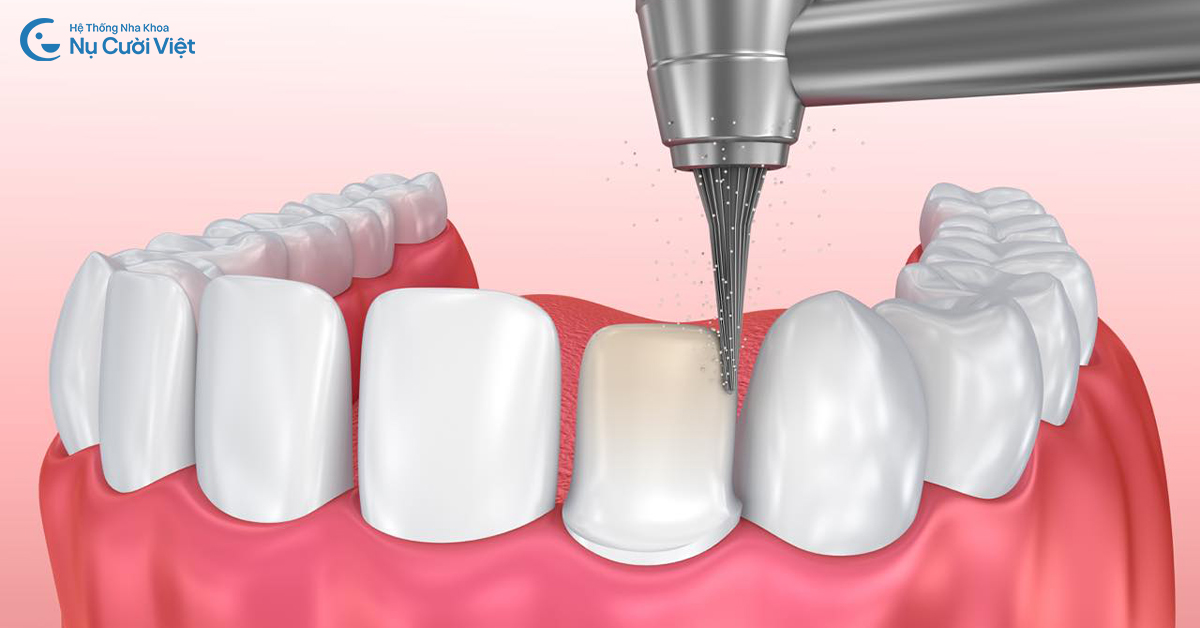 điều kiện niềng răng sau khi bọc sứ