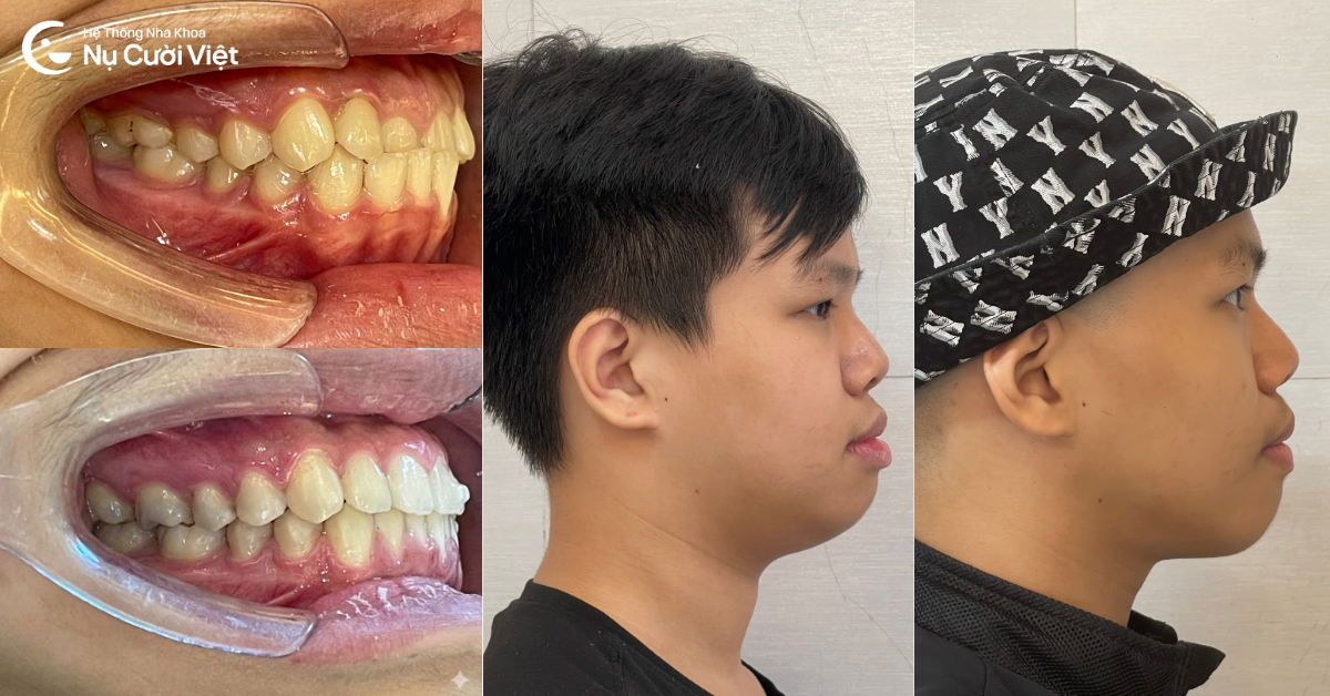 điều trị răng móm bằng niềng răng invisalign