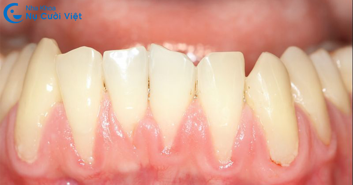 điều trị tụt lợi chân răng giai đoạn nặng