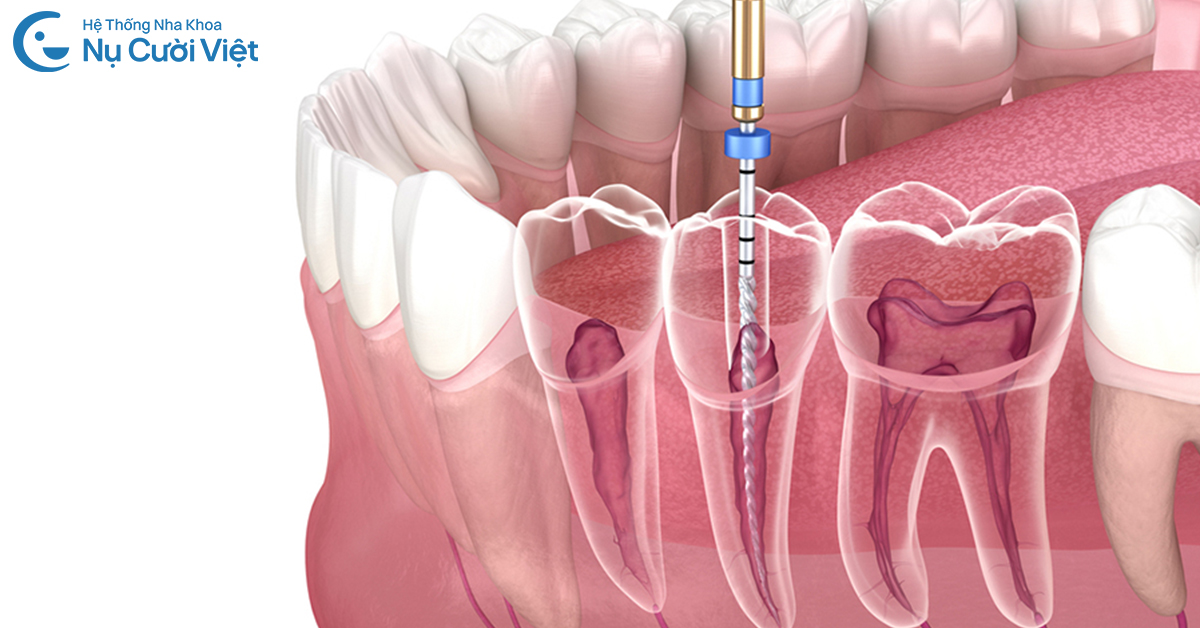 điều trị tủy an toàn