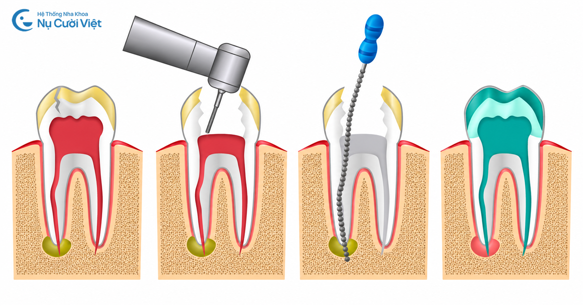 điều trị tủy giảm nhức răng