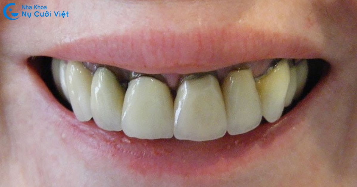 hậu quả bọc răng sứ gái rẻ đen viền nướu