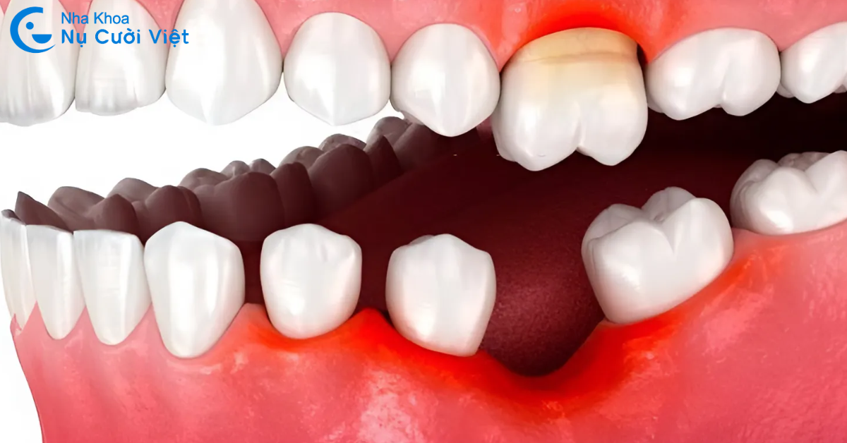 hậu quả của mất răng số 6