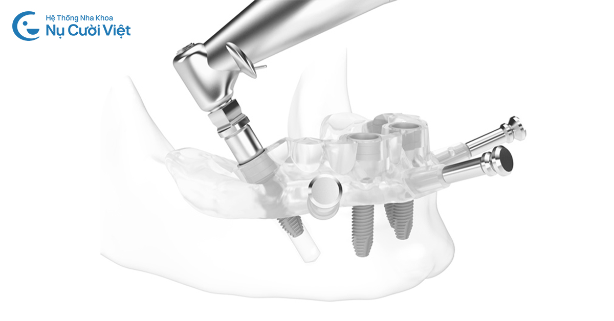 trồng implant bằng máng định vị sinh học gst