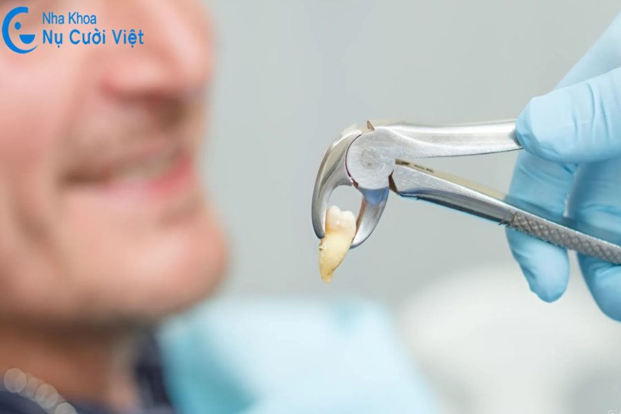 Nụ Cười Việt - KHÔNG NHỔ RĂNG KHÔN CÓ SAO KHÔNG? KHI NÀO NÊN NHỔ? TRƯỜNG HỢP NÀO KHÔNG CẦN THIẾT NHỔ?
