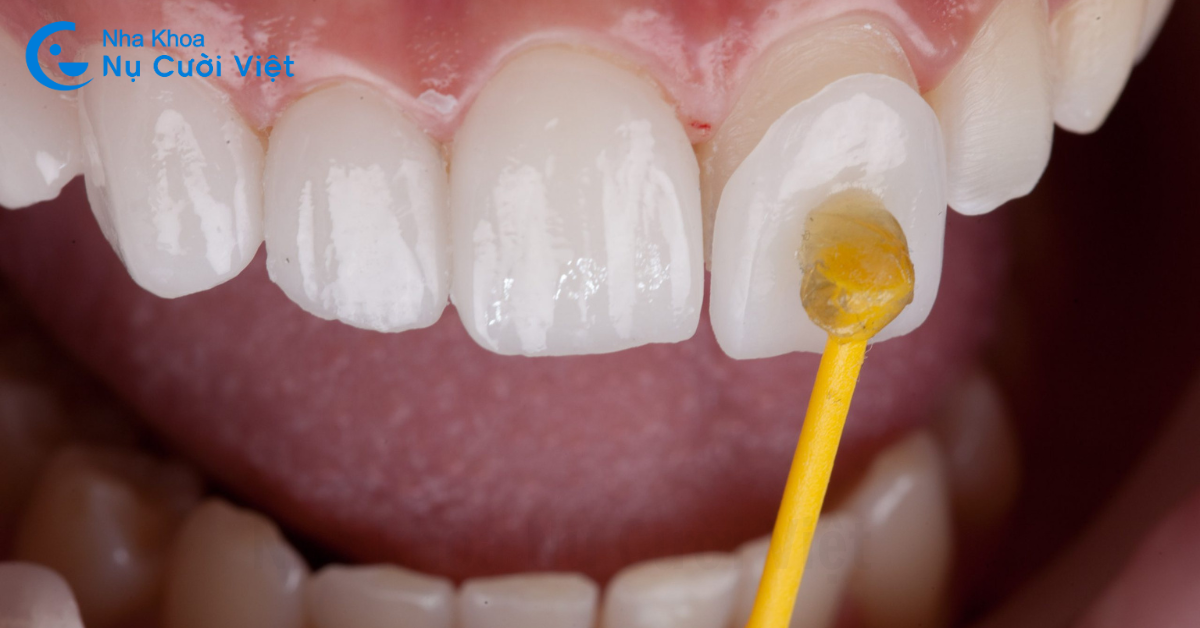 dán sứ phục hình sâu kẽ răng