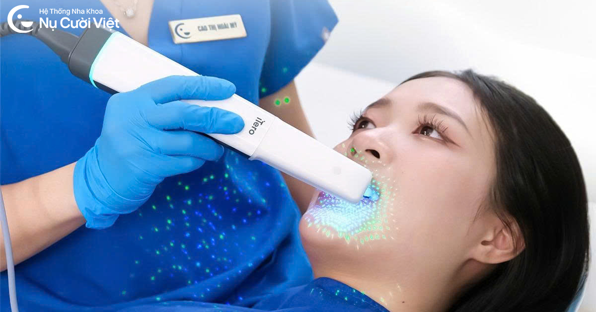 lấy dấu niềng răng itero lumina pro