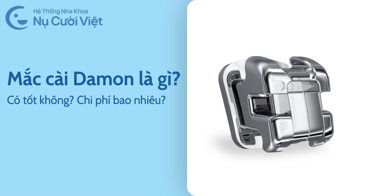 mắc cài damon có tốt không