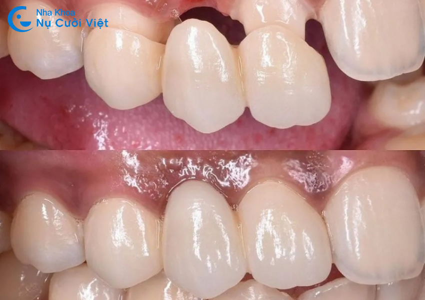 mài răng làm cầu răng sứ