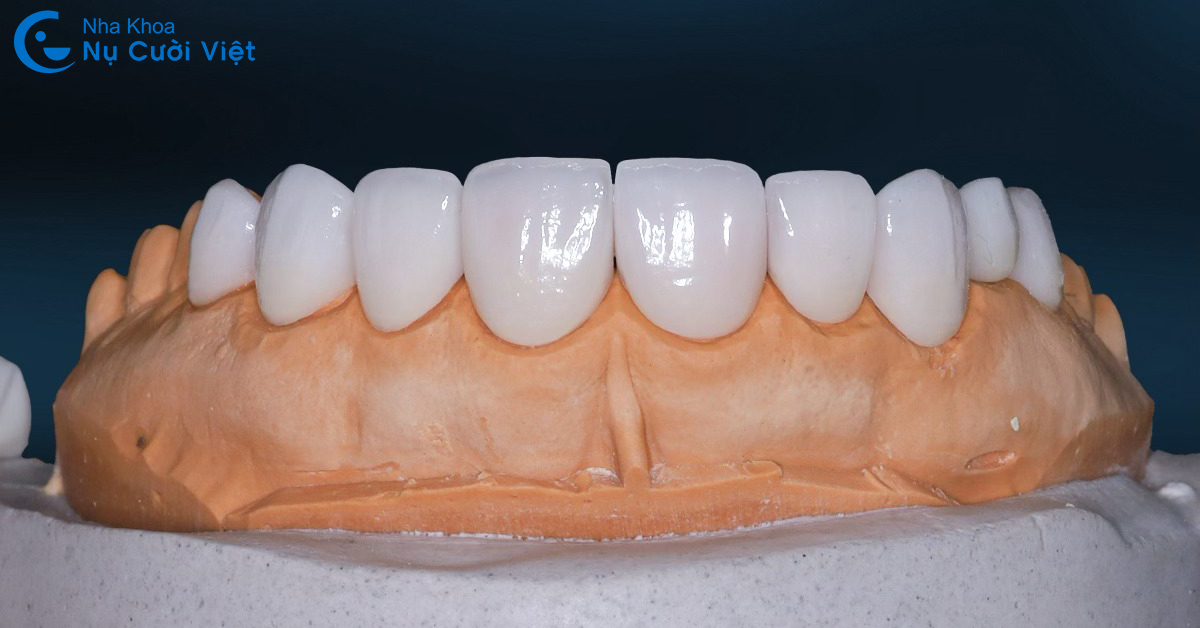 mặt dán sứ veneer có bền không