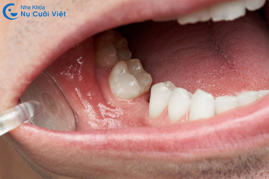 Nụ Cười Việt - Mất răng hàm có bị hóp má không? Nguyên nhân và cách khắc phục hiệu quả