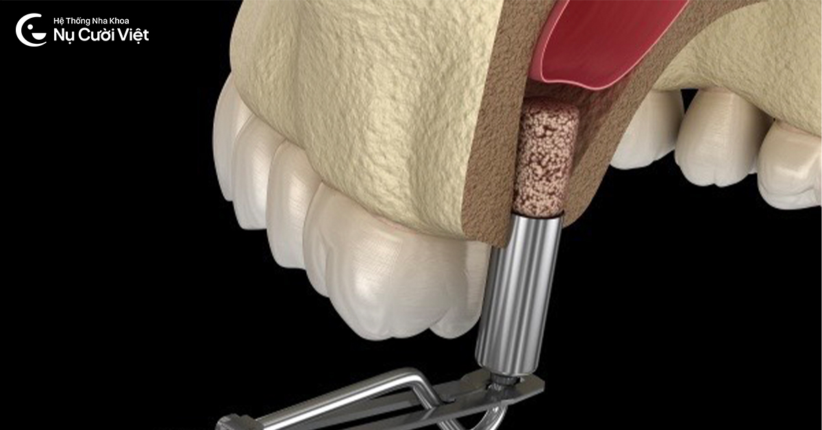 nâng xoang cấy ghép implant khi tiêu xương hàm