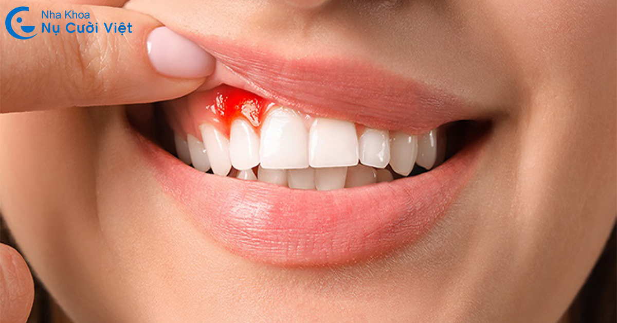nguyên nhân gây chảy máu chân răng