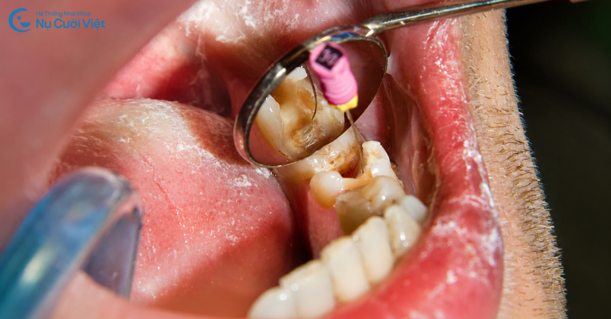 nguyên nhân lấy tủy răng xong bị đau