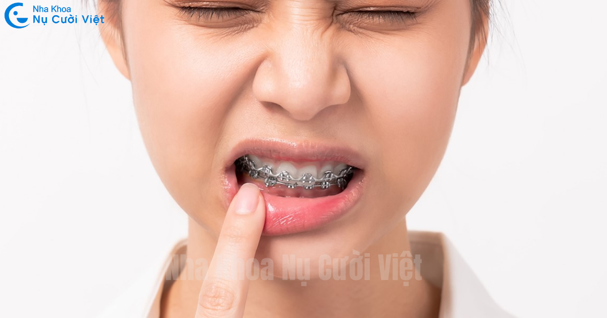 nguyên nhân niềng răng bị hóp má là gì