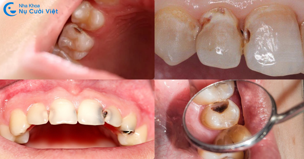 những dấu hiệu sâu kẽ răng