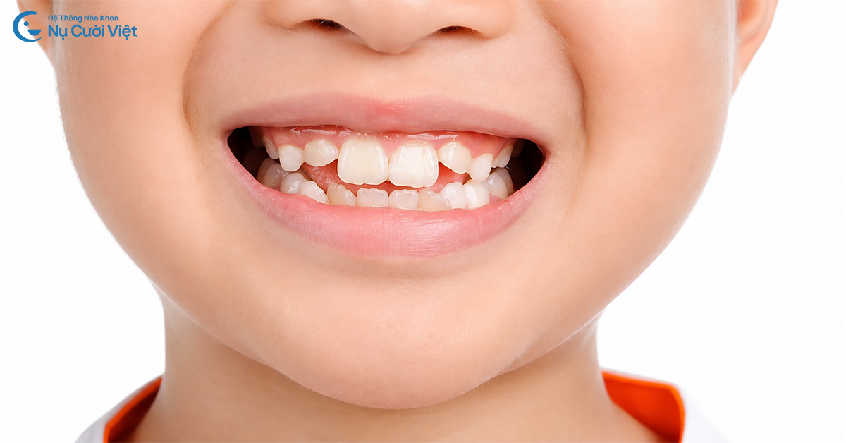 những trường hợp răng mọc bất thưởng ở trẻ em
