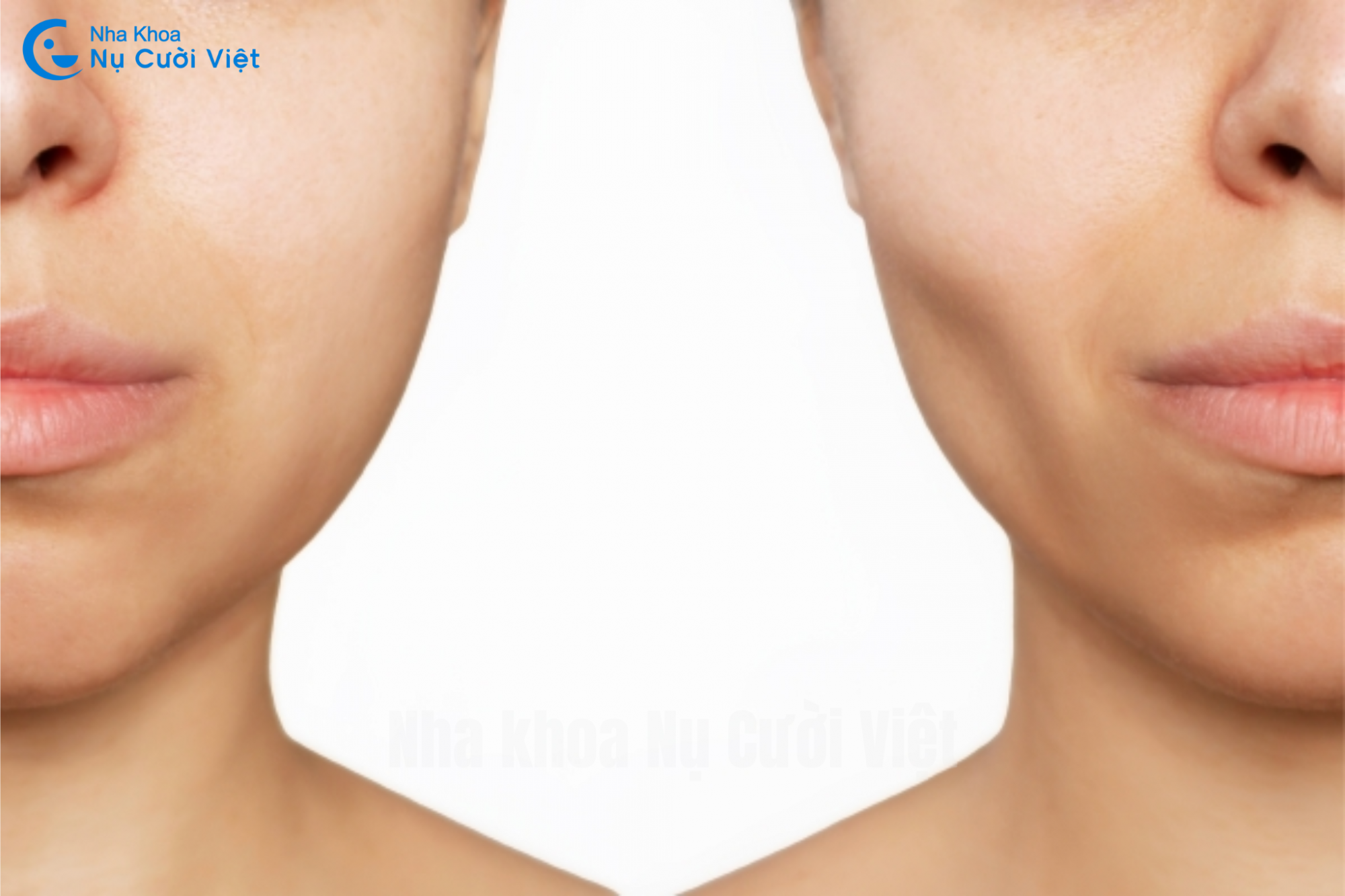 Nụ Cười Việt - Niềng răng bị hóp má: Nguyên nhân, cách khắc phục &  Làm sao để phòng tránh? 