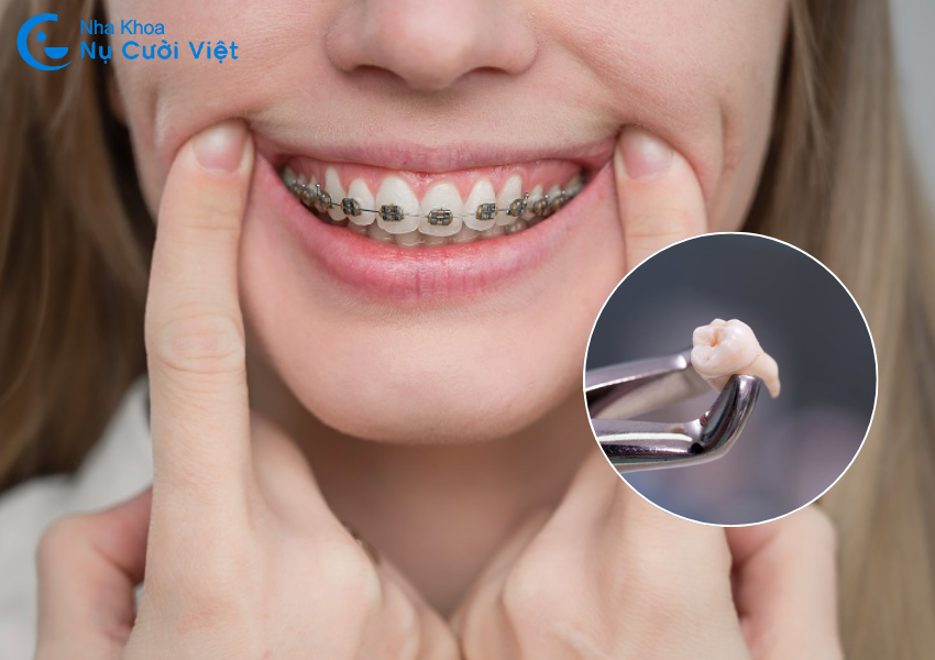 Nụ Cười Việt - Niềng răng có cần phải nhổ răng khôn không? Trường hợp  nào cần nhổ