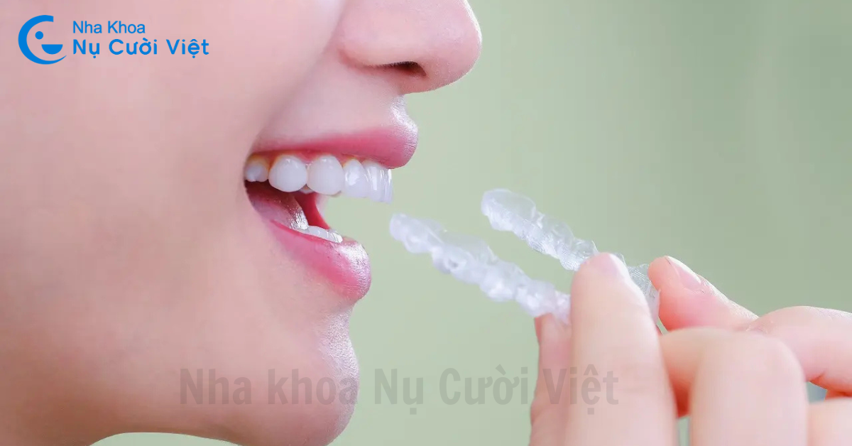 niềng invisalign có bị hóp má không