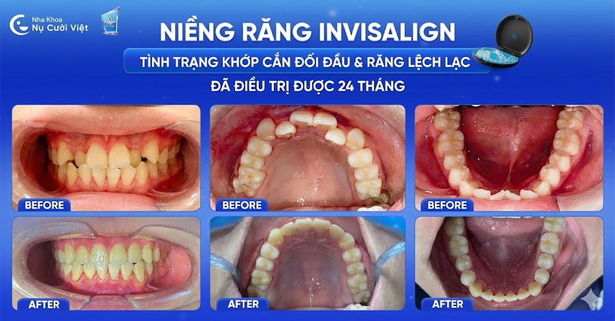 niềng răng khắc phục khớp cắn đối đầu