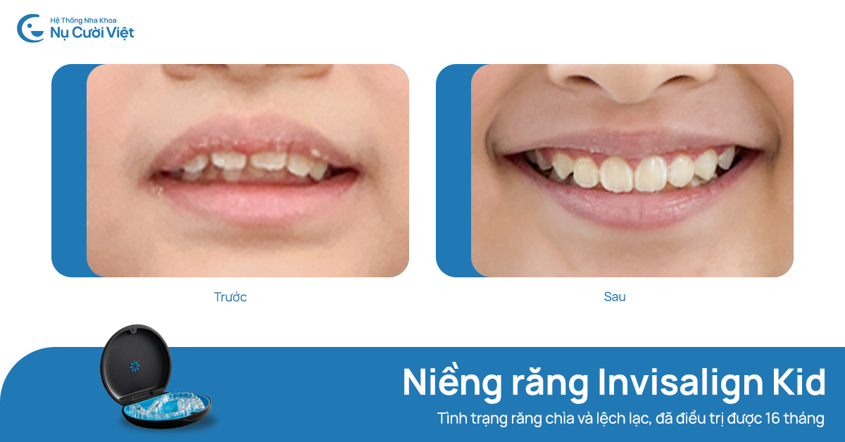 niềng răng thay đổi cung cười