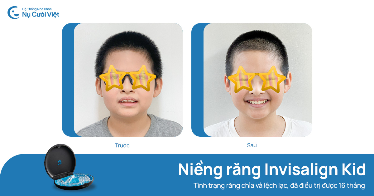 niềng răng thay đổi khuôn mặt không