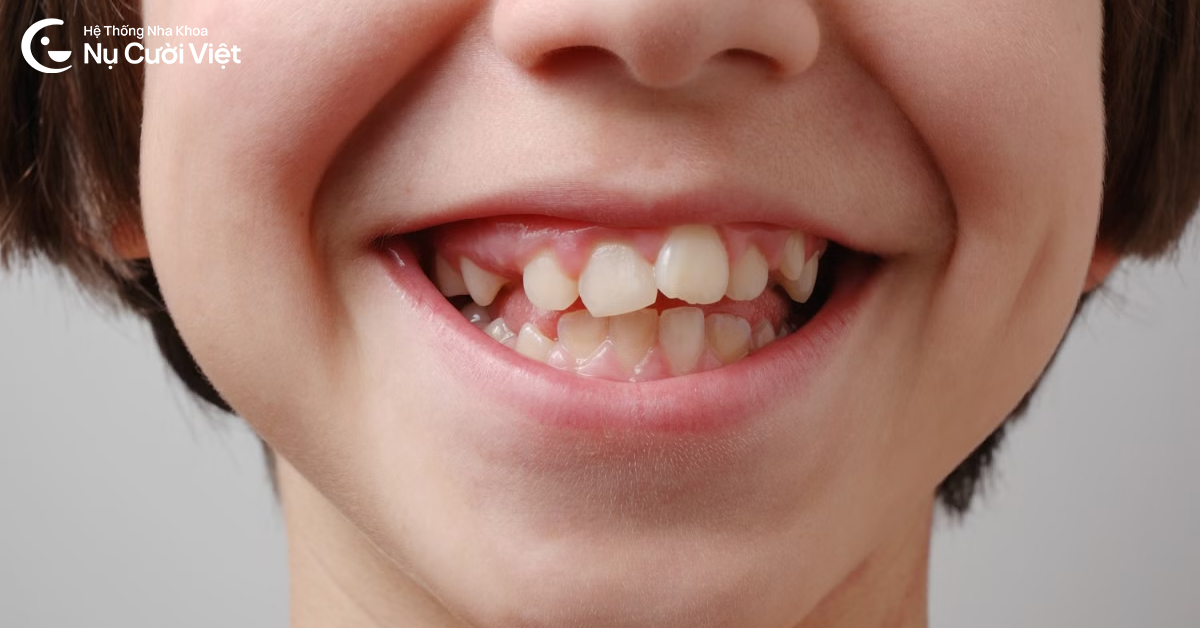 chi phí niềng răng trẻ em là bao nhiêu