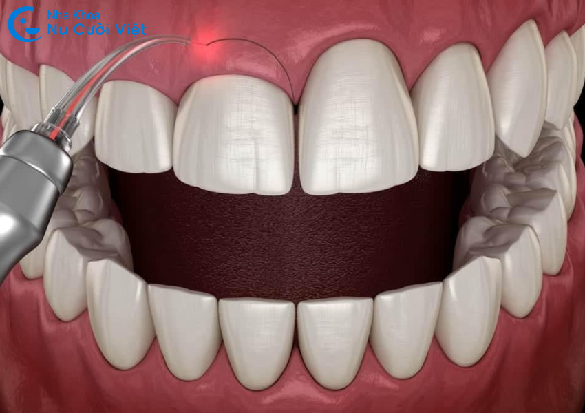 Nụ Cười Việt - PHẪU THUẬT CẮT NƯỚU LASER 3.0 CÓ ĐAU KHÔNG? QUY TRÌNH NHƯ THẾ NÀO?