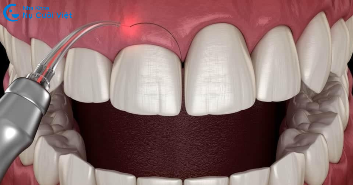 quy trình phẫu thuật cắt nướu bằng công nghệ laser 3.0